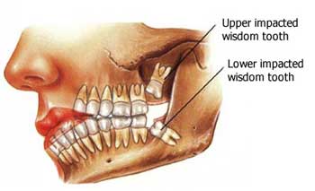 How Many Wisdom Teeth Do People Have?