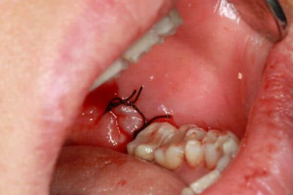 Wisdom Tooth Extraction Video