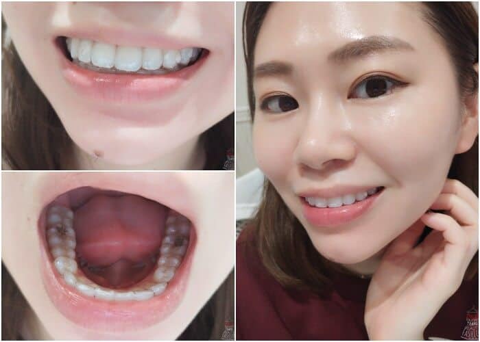 I Have Loose Teeth During Invisalign Is This OK?