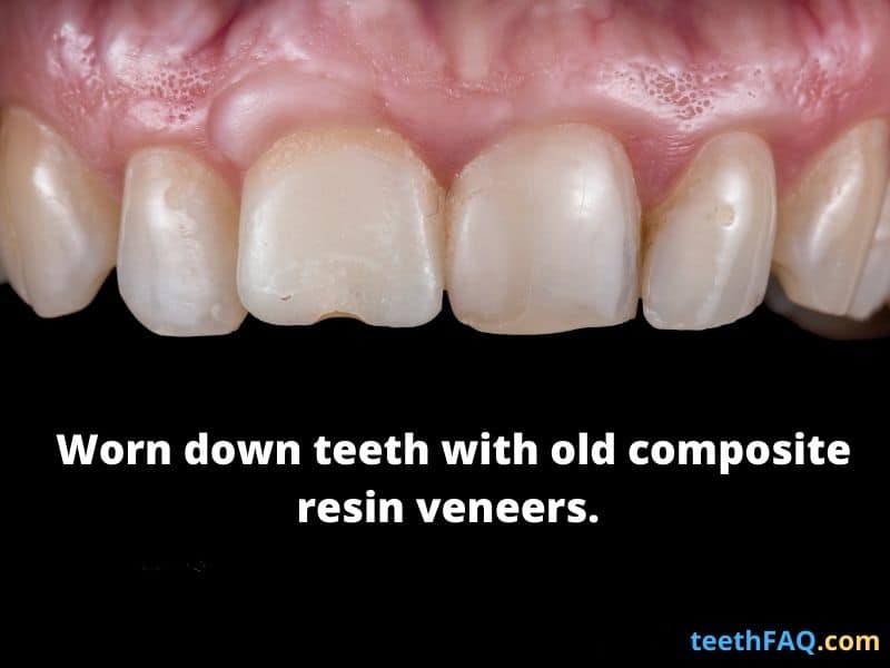 worn down teeth with resin veneers