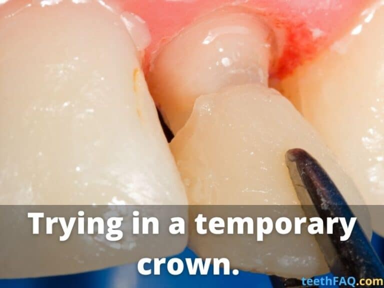 Temporary Crown Fell Off – What You Need to Do