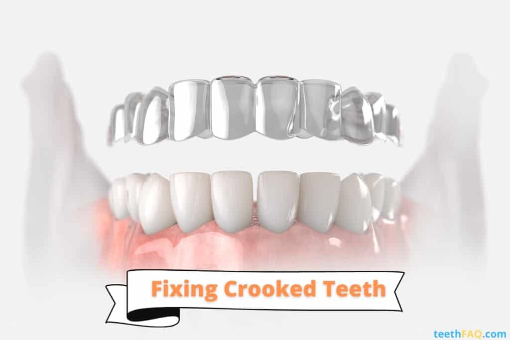 clear aligners to fix crooked teeth