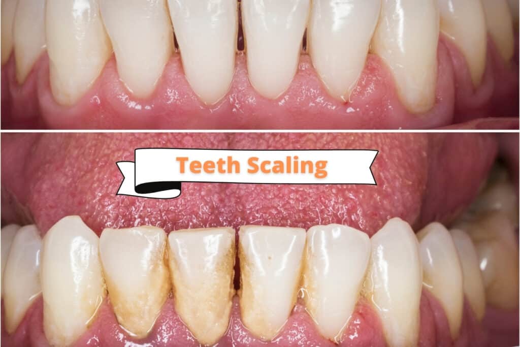 teeth scaling before and after